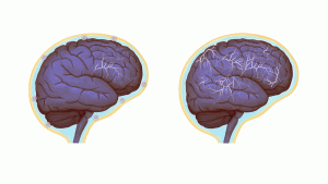 Normal brain activity, left, and a hyper-connected brain. (Images by Anita Impagliazzo, UVA Health System)